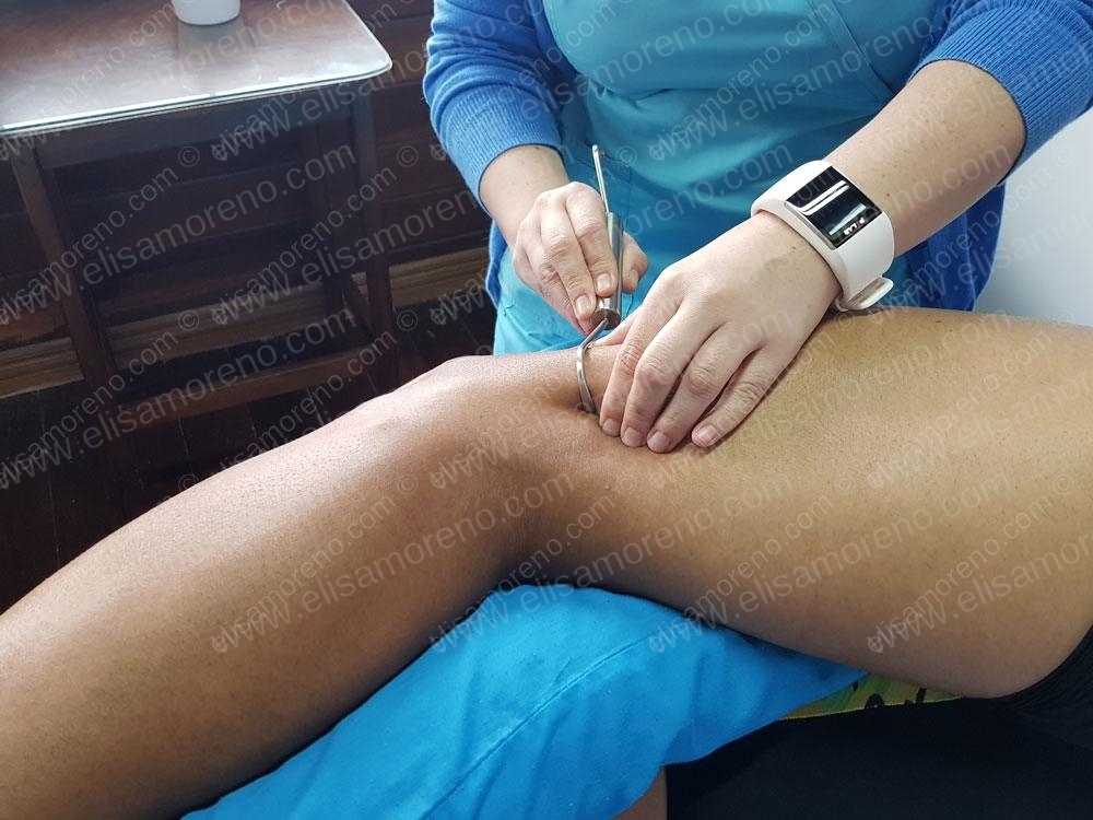 Fibrólisis diacutánea (Ganchos)