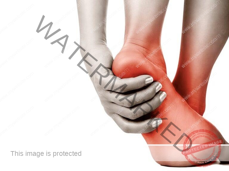 Fisioterapia en la Fascitis Plantar