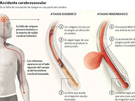 Rehabilitación tras Accidente Cerebrovascular ( ICTUS o Derrame)