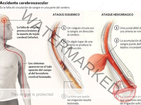 Rehabilitación tras Accidente Cerebrovascular ( ICTUS o Derrame)