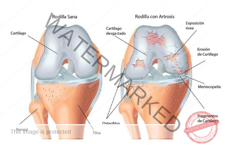 La artrosis o enfermedad degenerativa articular