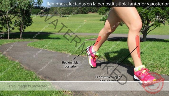 Dolor de pierna al correr – Periostitis